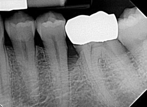 Tooth before regenerative therapy