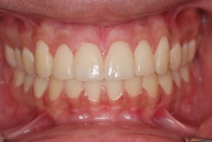 Patient's mouth after treatment of "gummy smile"