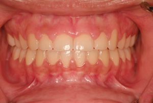 Patient's mouth before treatment of "gummy smile"