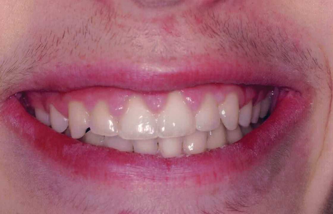 before